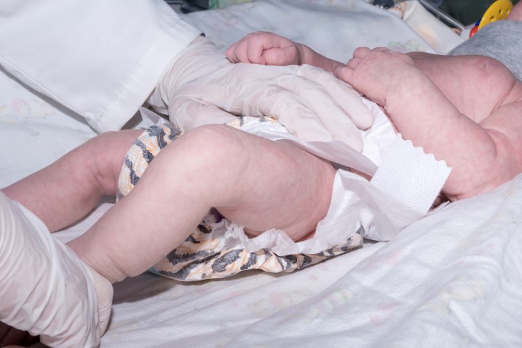 newborn baby with orthopedic collar on infant warmer in neonatal intensive care unit
